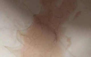 孕期小便有白色分泌物是正常现象还是感染信号？需注意哪些伴随症状？