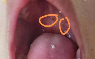 儿童急性化脓性咽峡炎的早期症状有哪些？如何区分普通感冒与细菌感染？