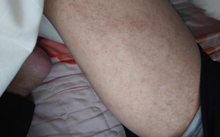 孕期大腿内侧摩擦红肿