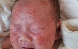新生儿湿疹可以晒太阳