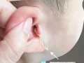 儿童耳朵痒痒是上火还是感染？家长该如何正确处理和预防？