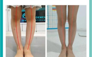 儿童O型腿矫正最佳时间是什么时候？错过是否会影响骨骼发育？