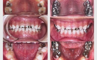 全麻补牙会对儿童的身体发育和认知功能产生哪些潜在影响？