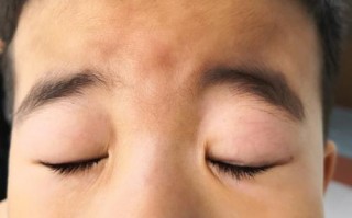 儿童鬓角处皮肤白图片是什么原因导致的？需要担心吗？