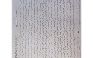 什么是视频儿童脑电图