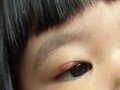 儿童霰粒肿肉芽肿图片是什么样？如何通过图片辨别霰粒肿与肉芽肿的区别？