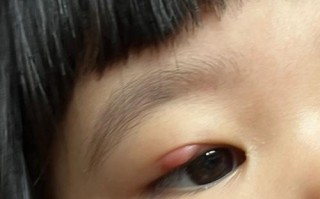 儿童霰粒肿肉芽肿图片是什么样？如何通过图片辨别霰粒肿与肉芽肿的区别？