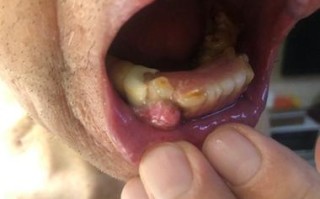 怀孕期间牙龈长肉瘤是孕期牙龈炎还是恶性病变？