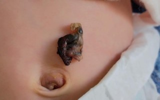 新生儿脐带脱落后，残留部分需要处理吗？护理不当会感染吗？