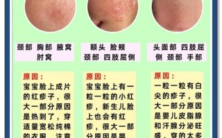 新生儿湿疹和痱子图片如何区分？