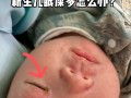 新生儿频繁长眼屎是上火还是疾病信号？需警惕哪些潜在原因？