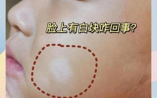 新生儿脸上出现的小白点到底是什么？需要担心吗？