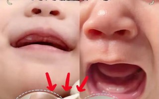 儿童牙齿歪斜不齐，会影响脸型和健康吗？该如何正确干预矫正？