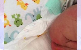 新生儿屁眼上面一个坑