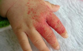 新生儿胆汁淤积的症状