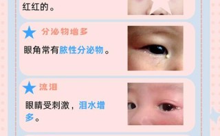 儿童眼睛红是上火还是疾病？家长该如何判断与处理？