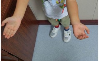 儿童肱骨髁上骨折后，何时开始锻炼？怎样锻炼才安全有效？