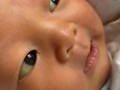 新生儿鼻子发黄一定是黄疸吗？需要区分生理性还是病理性原因吗？