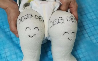 新生儿打石膏注意事项