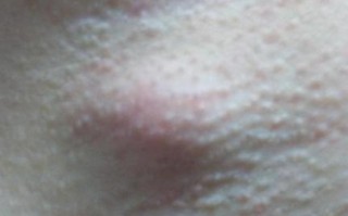 孕期腋下突然长两个疙瘩，是正常生理变化还是疾病信号？