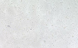 孕期尿检白细胞170严重吗？需要治疗吗？对胎儿有影响吗？