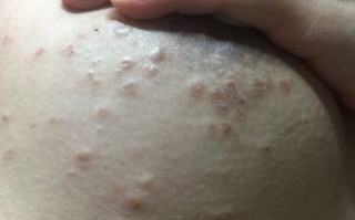 孕期乳头上长了小疙瘩是正常的吗？需要担心吗？