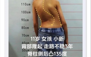 儿童强直性脊柱炎早期症状有哪些？