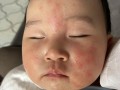 新生儿脸上有湿疹，能洗脸吗？