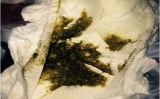 新生儿吸入胎粪的症状