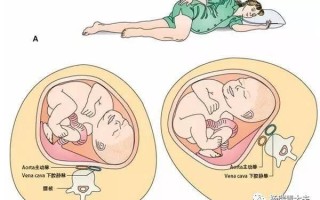 孕期外阴静脉曲张有哪些症状？如何缓解与预防？