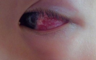 儿童眼睛过敏性结膜炎反复发作，家长该如何科学护理与预防？