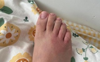 怀孕期间脚上突然长红点点，是孕期正常现象还是身体发出的健康警报？