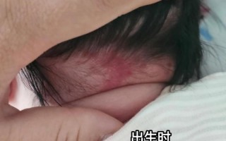 新生儿鼻翼两侧有红印