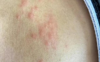 孕期带状疱疹图片大全，孕期感染带状疱疹的图片有哪些症状表现？