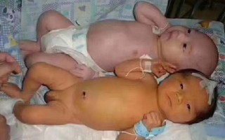 新生儿病理性黄疸有哪些典型症状？如何区分生理性与病理性黄疸？