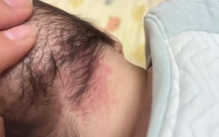 新生儿后脑勺红斑图片显示的是什么情况？需要担心吗？