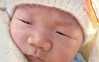 新生儿一只眼睛睁不开是先天畸形还是生理性水肿？需立即就医排查吗？