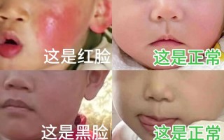 新生儿两侧脸颊不对称