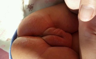 新生儿肛门周围红破皮