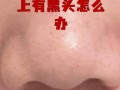 儿童鼻子长黑头怎么办？日常清洁与护理的正确方法是什么？