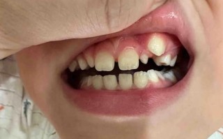 儿童牙龈上长牙齿是正常现象吗？需要处理吗？