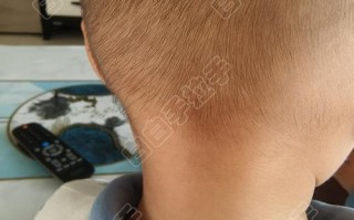 儿童纤维性骨皮质缺损到底是什么病？家长必须了解的成因、症状与治疗全攻略