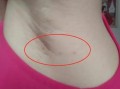 孕期腋下突然长小肉瘤是肿么回事？会对宝宝有影响吗？
