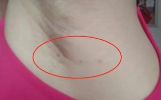 孕期腋下突然长小肉瘤是肿么回事？会对宝宝有影响吗？