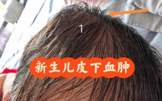 新生儿头上的血肿变硬