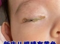 新生儿眼睛流黄色液体