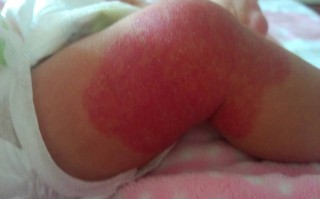 新生儿红色胎记会自行消退吗？如何判断是否需要治疗？