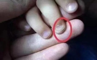 儿童手指甲起层是缺乏营养还是疾病信号？附图片详解原因及应对方法