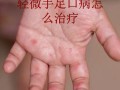 儿童手足口病怎么治疗？有哪些科学有效的护理方法和用药建议？