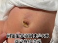 新生儿肚脐掉一半正常吗？需要处理还是等自然脱落？